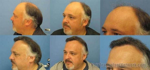 Left side photos of before and after hair transplant