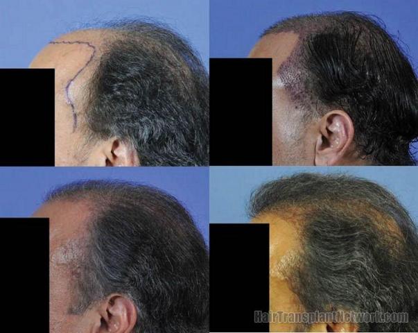 Viewing left side hair replacement surgery results