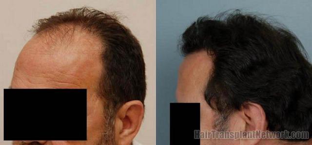 Hair restoration picctures showing left side before and after