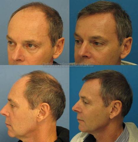 Hair transplantation surgery before and after pictures