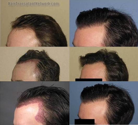 Left view before and after hair transplant