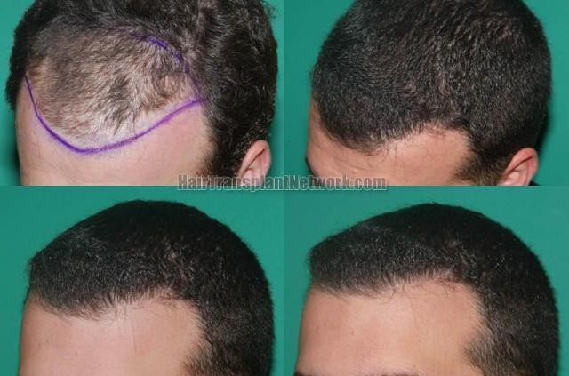 Hair restoration procedure before and after results