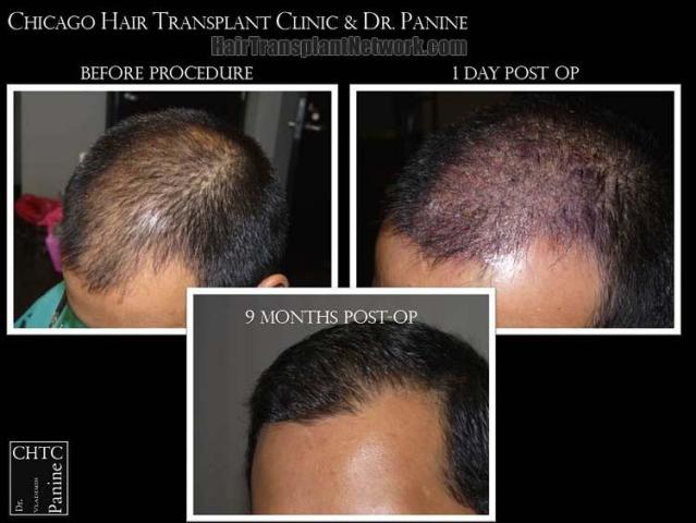 Hair transplantation surgery before and after images