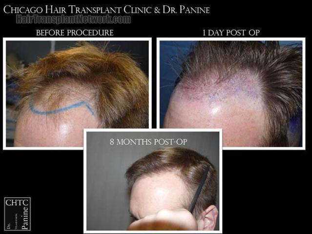 Hair transplantation surgery before and after pictures