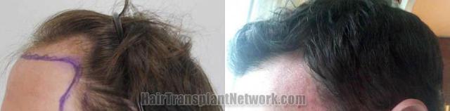 Hair restoration procedure before and after pictures