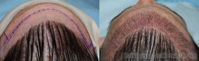 Before and immediate postoperative hair transplant results