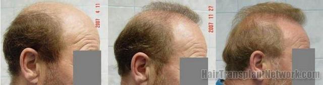 Right view of hair replacement surgery photos