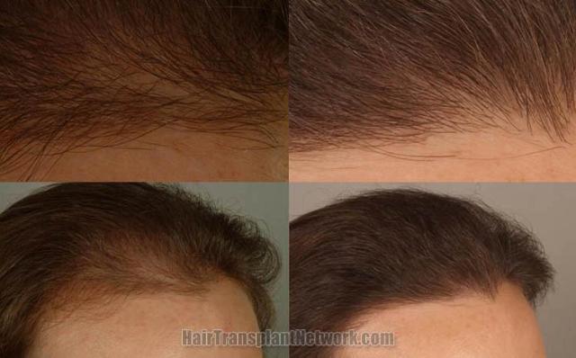 Before and after surgical hair transplantation