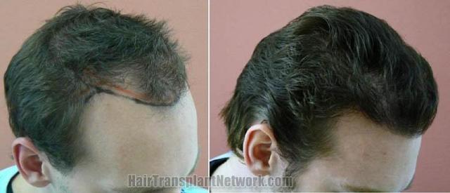 Before and after hair transplantation result photographs