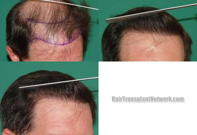 Hair restoration procedure before and after results