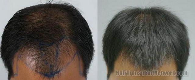 Thai male hair restoration top view