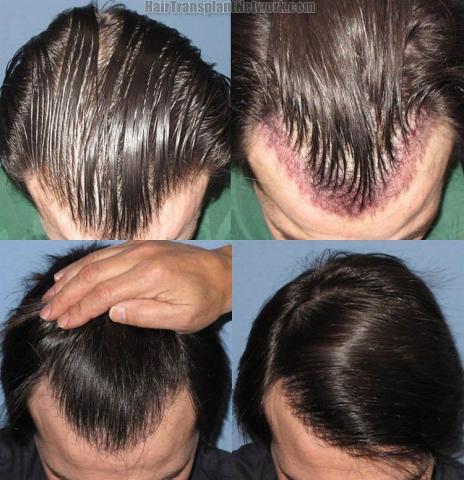 Hair transplant photos viewed from the top