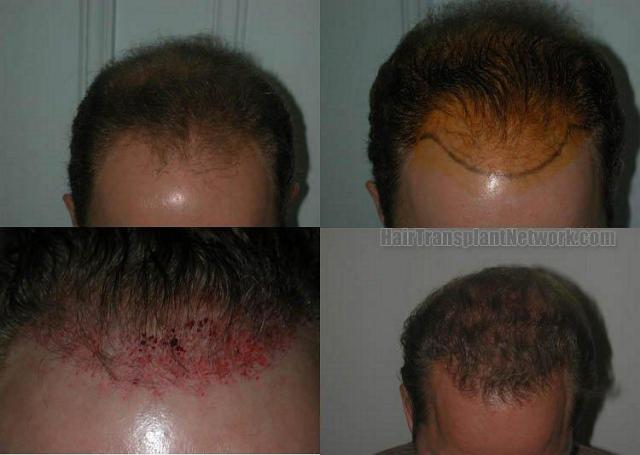 Before and after pictures from 2115 grafts hair transplant