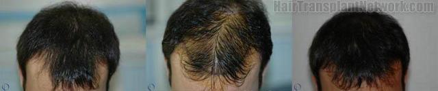 Pictures showing before and after hair transplant results