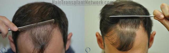 Hair transplantation surgery before and after photos