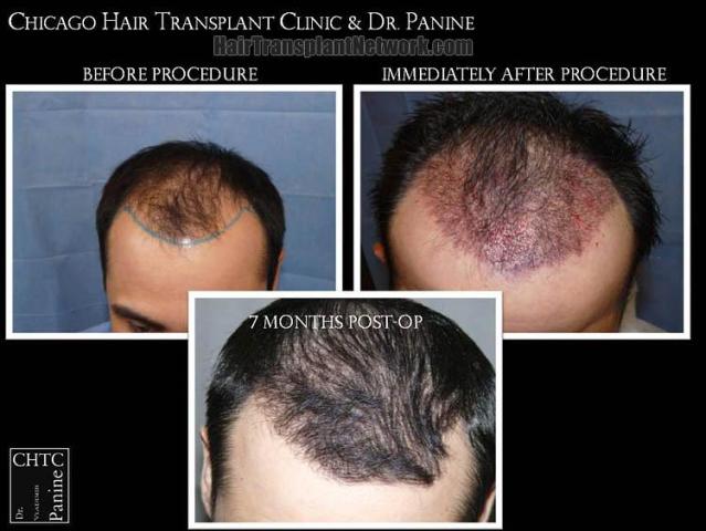 Hair transplantation surgery before and after photos