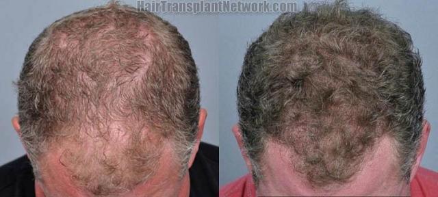 Hair transplantation surgery before and after photos