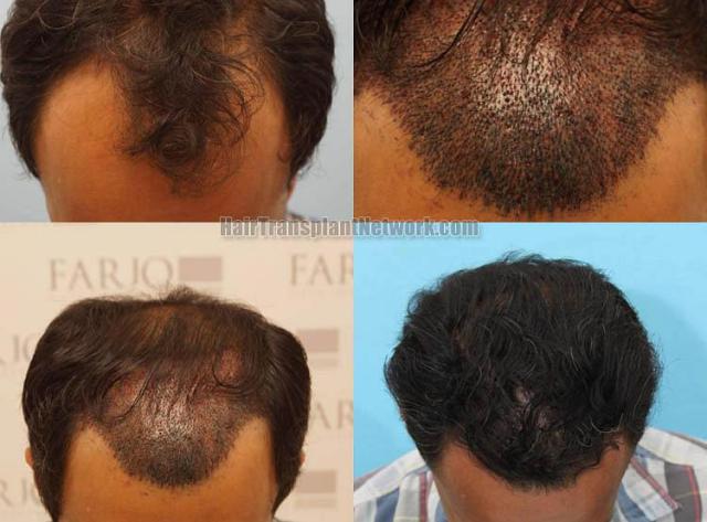 Hair transplantation surgery before and after photos