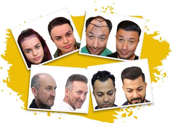 Hair Transplant Photos