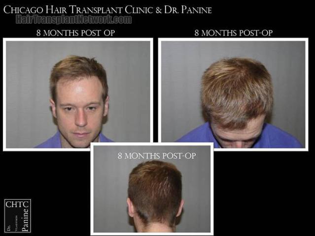 Hair restoration procedure before and after pictures