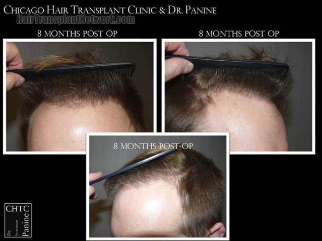 Hair restoration surgery before and after photos