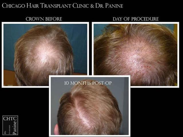 Hair transplantation surgery before and after pictures