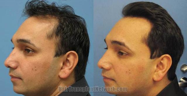 Left view before and after hair restoration procedure