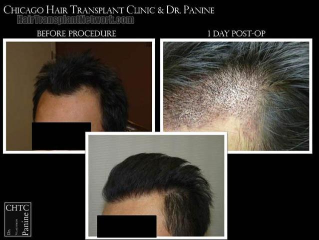 Hair transplantation surgery before and after images