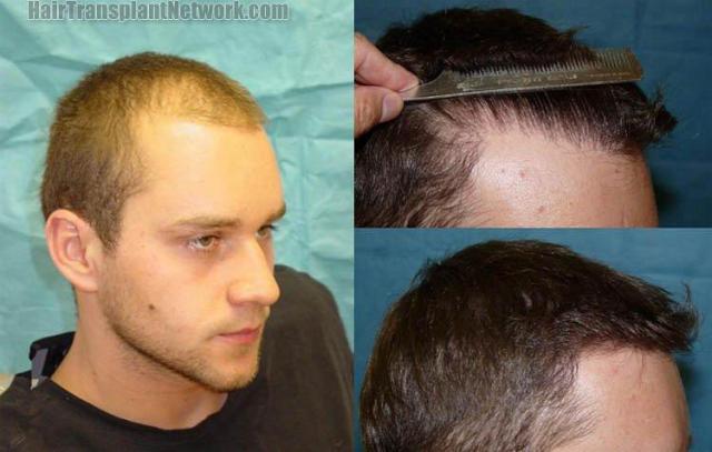 Right side hair transplant before and after photos