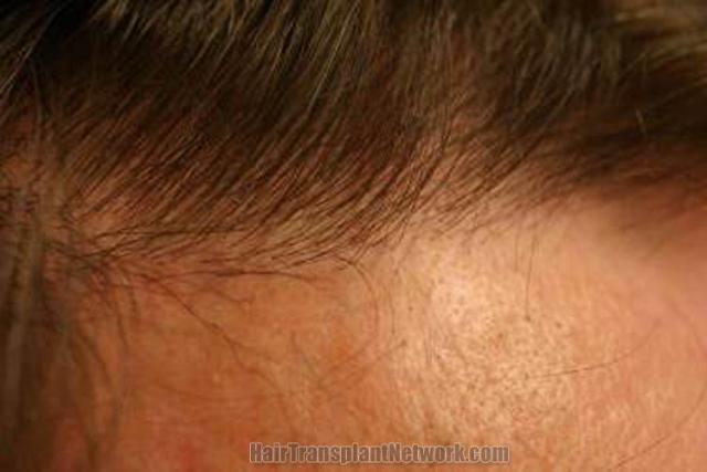 Hair restoration procedure results