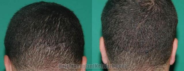 Back view before and after hair transplantation photos