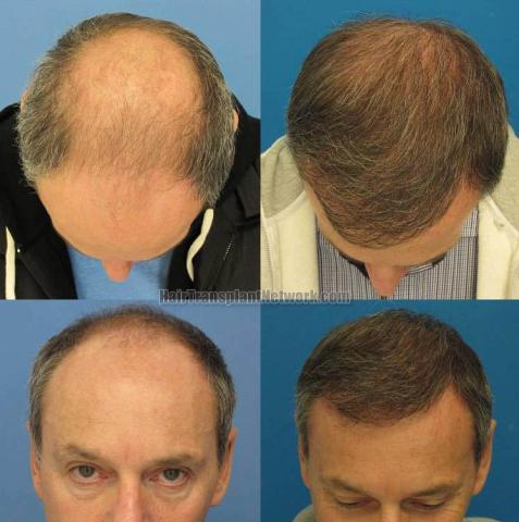 Top view before and after hair restoration procedure