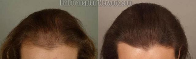 Female hair restoration photo results