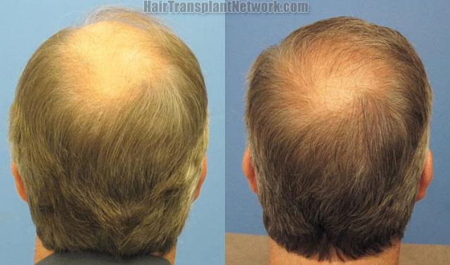 Back view before and after hair restoration procedure