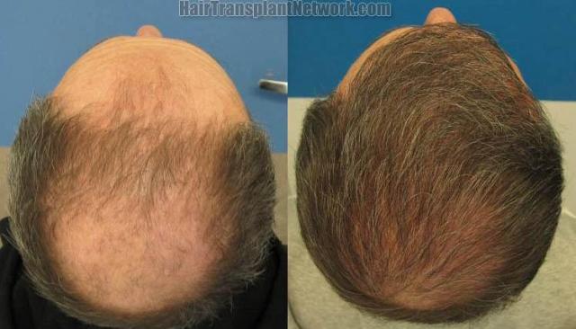 Back / Crown view hair transplant results