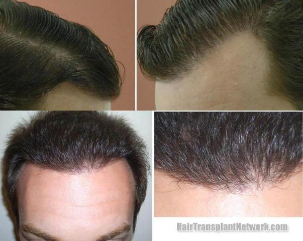 Hair transplantation surgery before and after pictures