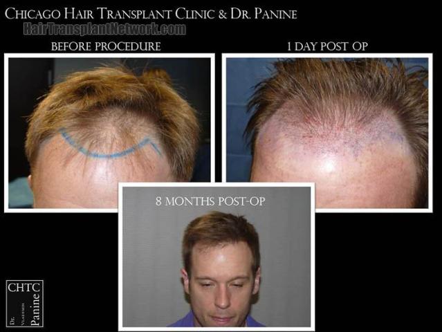 Hair transplantation surgery before and after photos