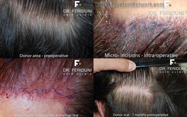 Intraoperative photos of hair restoration procedure