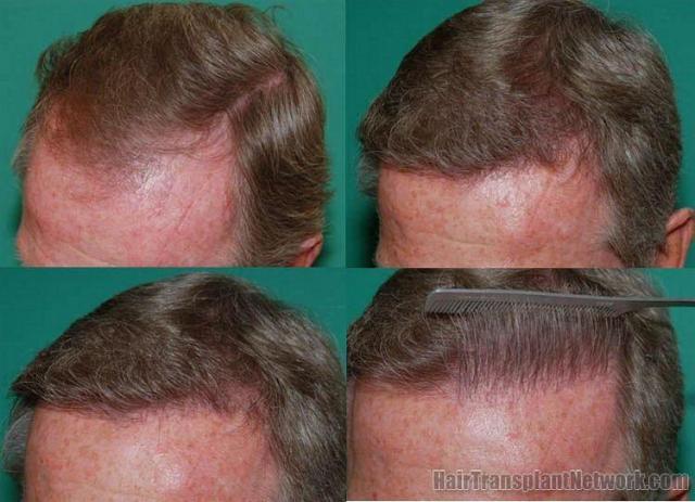 Left side showing before and after hair restoration 