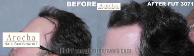 Hair transplantation surgery before and after pictures