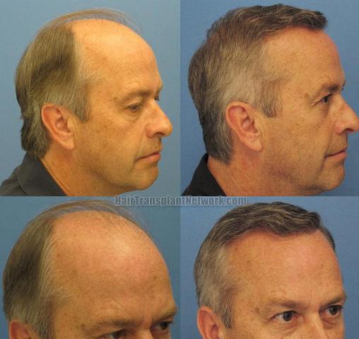 Before and after right view hair transplant photos