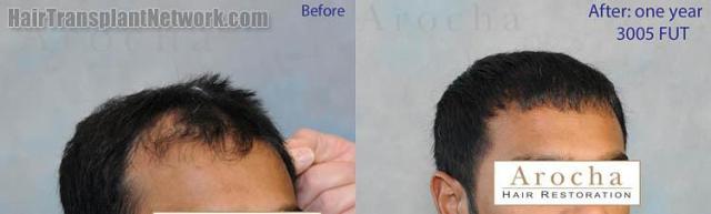 Hair transplantation surgery before and after images