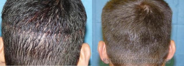 Residual scar after hair restoration procedure