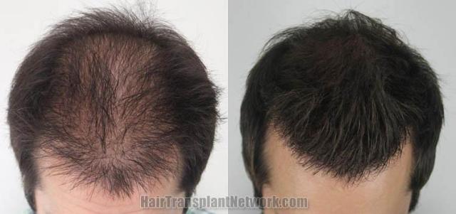 Hair transplantation surgery before and after pictures