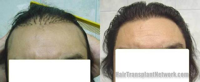 Hair transplant before and after repair photos