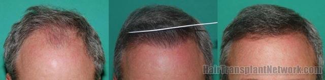 Before and after hair transplantation photos
