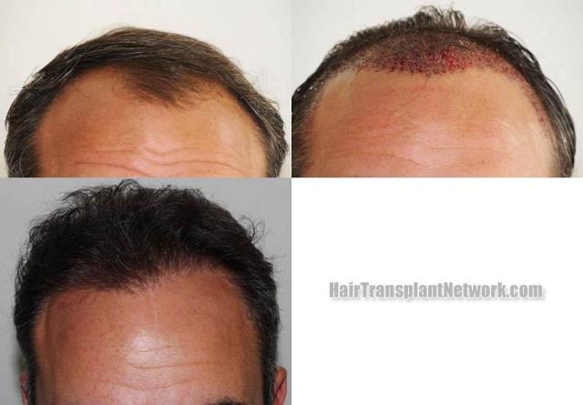 Before and after hair restoration repair surgery