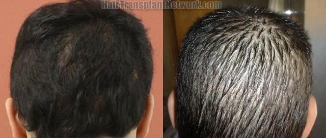 Hair transplantation surgery before and after pictures