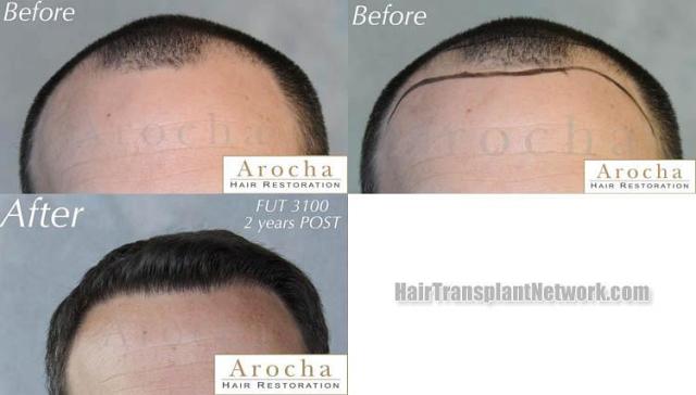 Hair restoration procedure before and after results