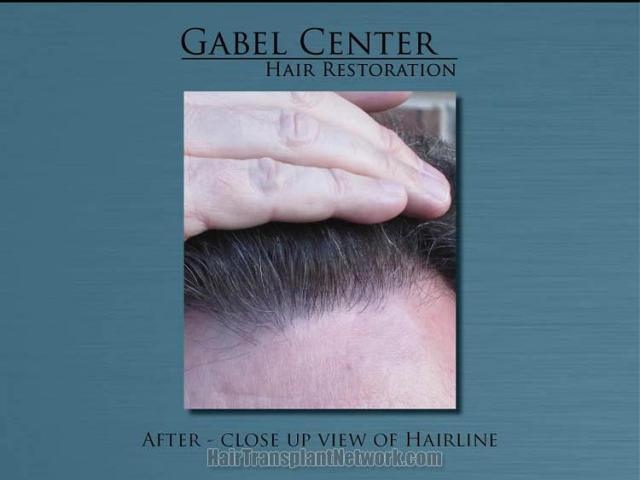 Closeup view of hairline one year postoperative